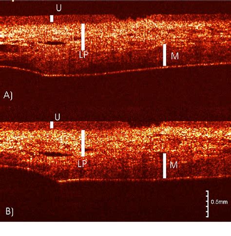 Figure From In Vivo Bladder Imaging With Microelectromechanical