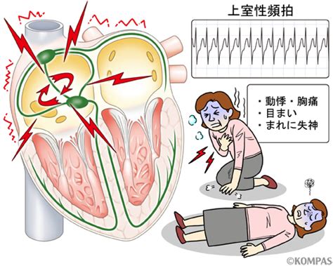 発作性上室性頻拍・心室頻拍｜kompas