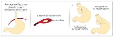 Hernie Hiatale Reflux Gastro Oesophagien Chirurgie Viscerale Saint