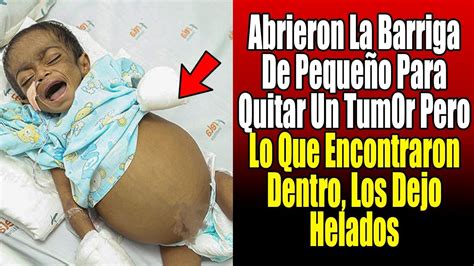 Medicos Pensaron Que Ni Ten A Un Tumor Doctor Se Desmayo Al Ver Lo