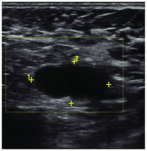 Axillary Lymph Nodes Ultrasound