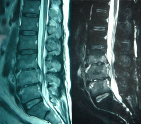 L3 L5 Brucellar Spondylitis Mri Showed Thin And Unevenly Enhanced