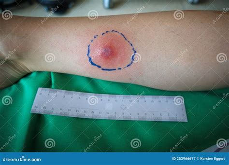 Tick Bite Has Caused Abscess On A Forearm A Ruler Is Lying Next To It