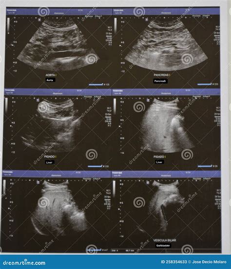 Ultrasonography Of The Upper Abdomen With Visualized Portions Of