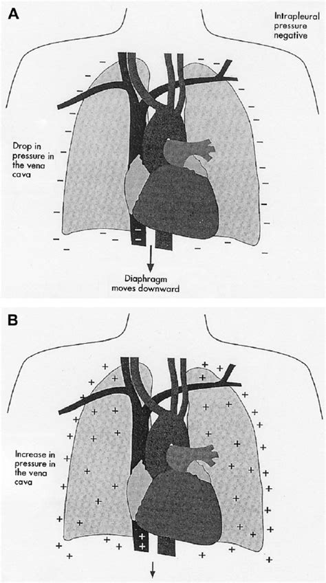 Intrathoracic pressure is reflected upon the structures in the closed ...