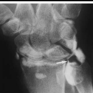 Drawing of a coronal wrist arthrogram demonstrates locations 1-5 ...