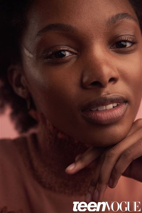 Meet 5 Models With Facial Scars Teen Vogue