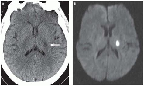 Lacunar Infarct