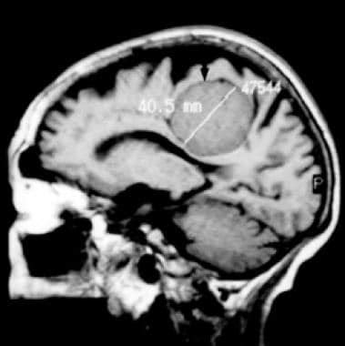 Meningioma Brain Mri