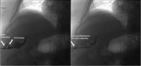 Diagnosing Gallbladder Perforation With Contrast Enhanced Ultrasound A