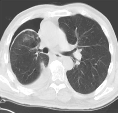 Trapped Lung Syndrome - The Clinical Advisor