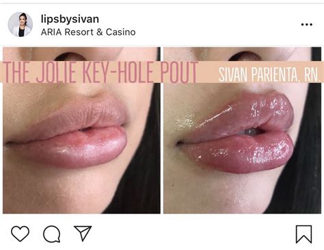 Key Hole Lip Filler Botox Lip Fillers Dark Skin Makeup Fake Lips