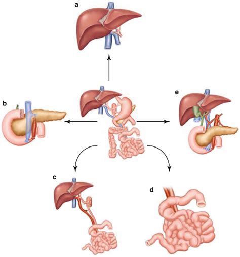 Historical Review Of Solid Organ Transplantation Springerlink