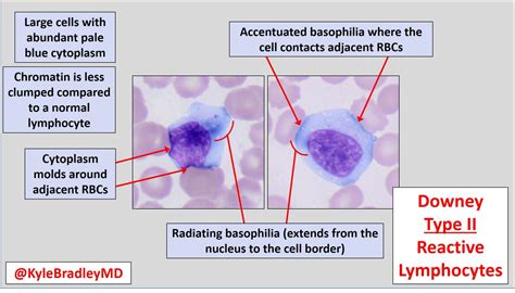 Reactive Lymphocytes Vs Monocytes