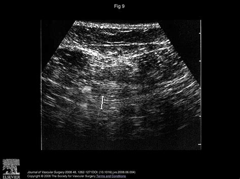 Duplex Ultrasound Changes In The Great Saphenous Vein After