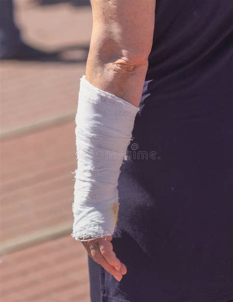 Broken arm. Arm in cast stock photo. Image of sling - 166441366