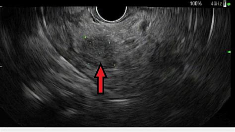 Endoscopic Ultrasound Image Red Arrow Shows A 15 Mm Mass In The Head