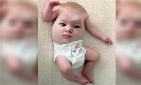 Baby Born With Face On Torso and No Head Might Be ‘Creepiest Ever ...