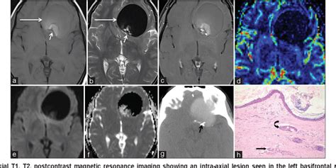 Figure 1 From Unusual Radiological Presentation Of Intracranial Dermoid