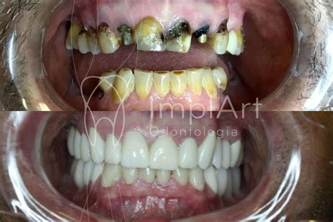 Coroas Metaloceramicas Implantes Reabilitacao Antes E Depois 50kb