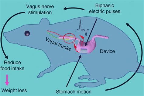 Implantable Vagus Nerve Stimulation Device Aids Weight Loss Sci News