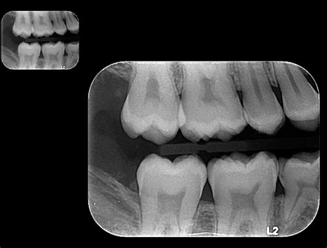 Radiograf As Intraorales Rxm Radiologia Maxilofacial