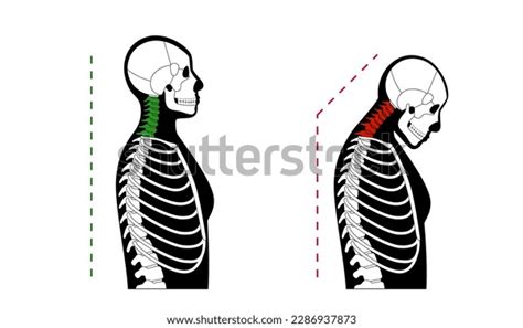 Diagram Deformation Cervical Vertebrae Neck Spasm Stock Vector Royalty