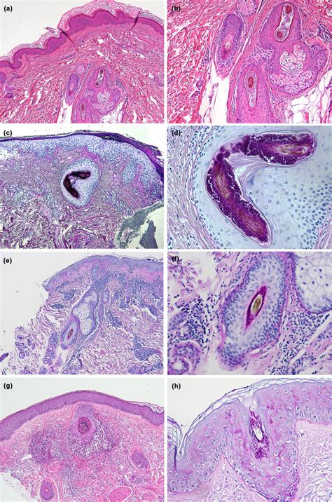 Tinea Histopathology