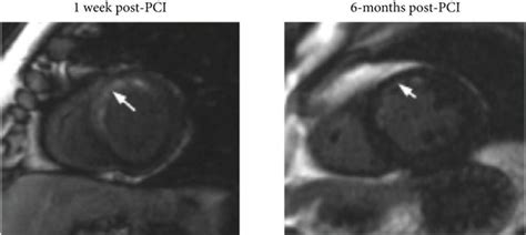 Association Of Cmr Derived Infarct Size With T Cell Count In Stemi