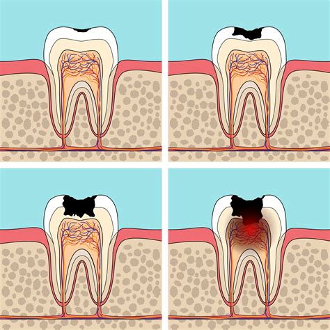 5 Stages Of Tooth Decay Archives Patient Empowered Dentistry