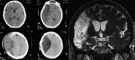 Isquemia Cerebral Cirug A Neurol Gica Integral De Oriente