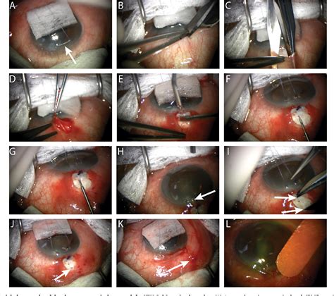 Figure 2 From Effective Treatment Of A Normal Tension Glaucoma Patient