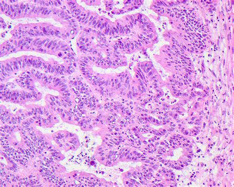 Pathology Outlines Adenocarcinoma Small Intestine