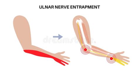 nerve entrapment stock illustrations  nerve entrapment stock