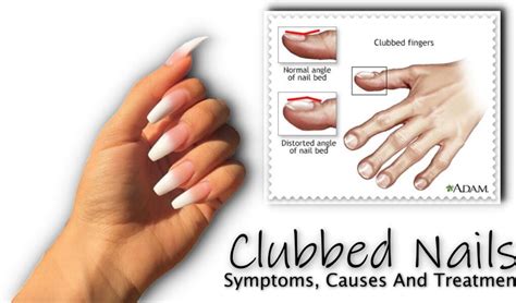 Clubbed Nails : Symptoms, Causes And Treatment - Fancy Nail Art