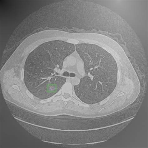 Lung Cancer NormAug Training Instance Segmentation Dataset V1 2023 07