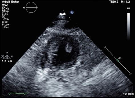 B Mode Short Axis View Demonstrating Left Ventricular Thrombus Download Scientific Diagram