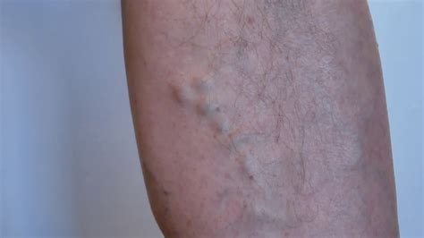 Bulging or Popping Veins: Causes & Treatments