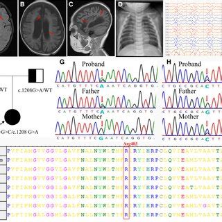 Clinical and molecular findings of the patient. (A) T1-weighted (T1W ...