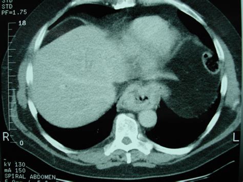 Initial Ct Scan Revealed A Large Mass In The Distal Third Of The Esophagus Download