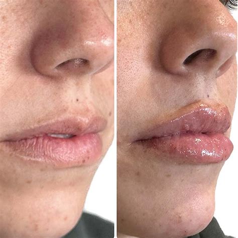 Lip Fillers In San Antonio Tx Cutella Medical Spa