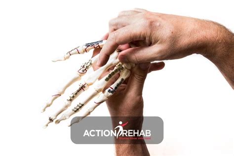 volar plate injuries treatment action rehab