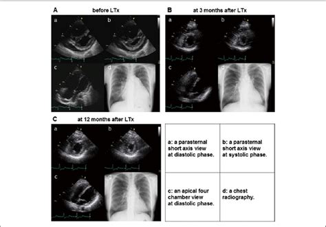 Representative Case Of Idiopathic Pulmonary Arterial Hypertension