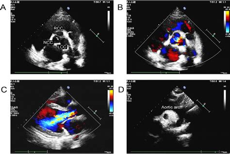 Figure From Role Of Echocardiography In The Assessment Of Cardiac