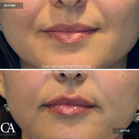 Lip Injections Before After Chicago Aesthetics Medspa