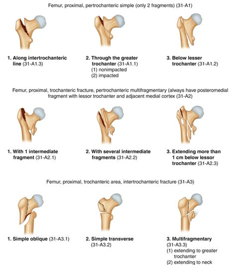 Fig. 9.3, [AO/OTA Classification for trochanteric fractures (Reproduced ...