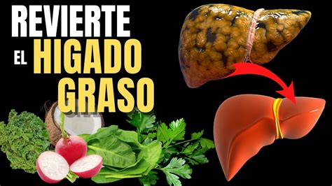 CÓMO REVERTIR UN HÍGADO GRASO HOW TO REVERSE A FATTY LIVER YouTube