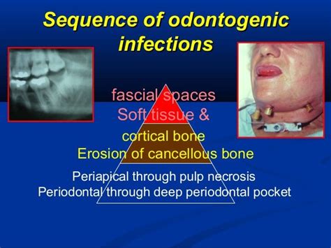 Odontogenic Infection