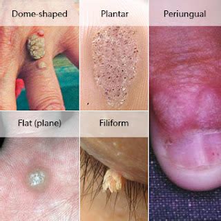 Moles, Warts & Skin Tags Removal: Types Of Warts And Treatment