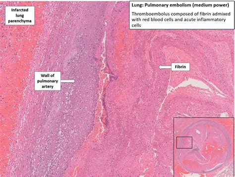 Heart With Lungs Thromboembolism Nus Pathweb Nus Pathweb